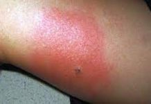 Chepes: Alertan por la presencia de alacranes