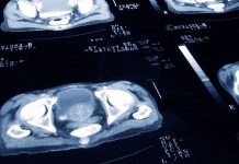 El estudio que revela que el cáncer de próstata se puede curar con menos sesiones de radioterapia (y el “enorme cambio” que significa en el tratamiento de la enfermedad)